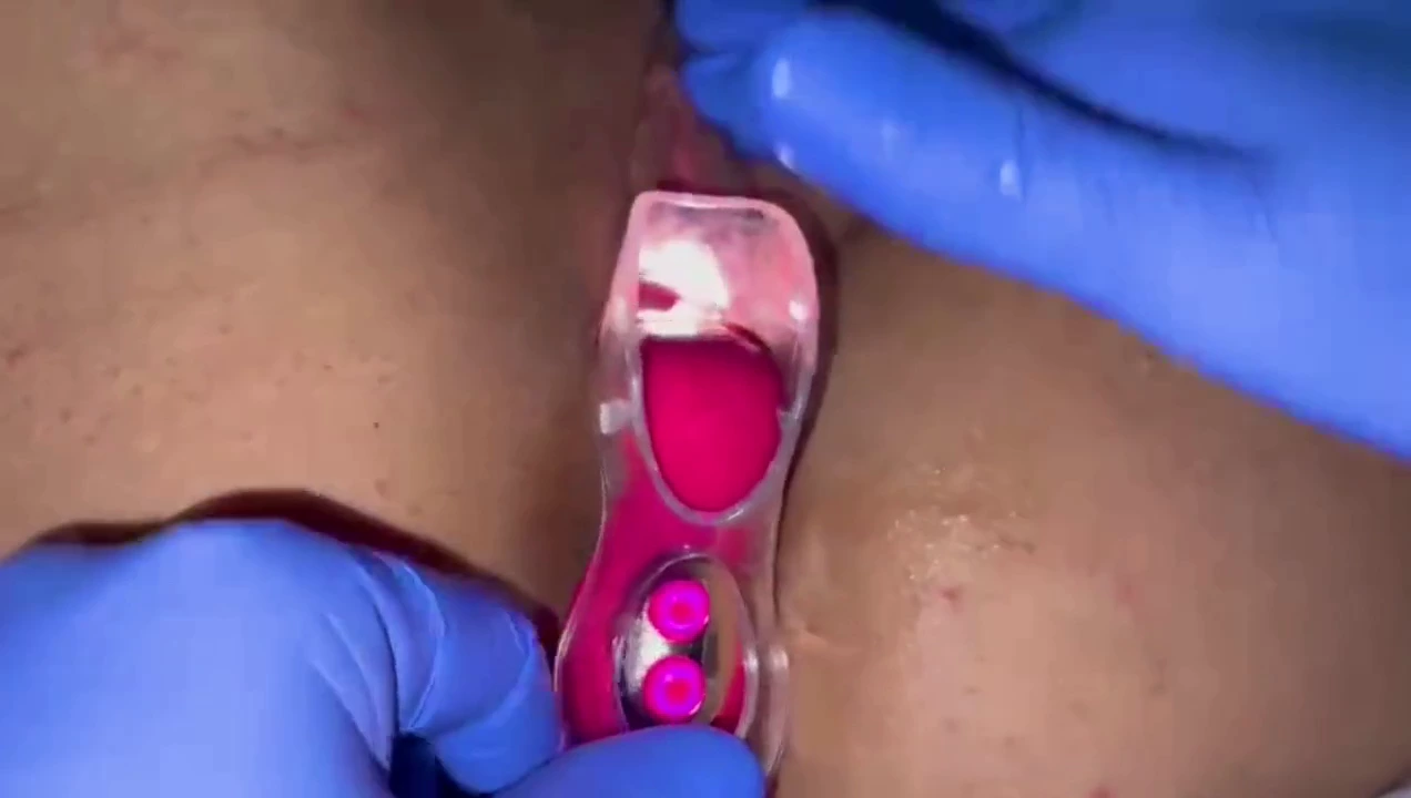 Watch Speculum, vaginal speculum, cunt speculum, erotic speculum porn movies and download speculum, sexy speculum, speculum dildo streaming porn to your phone